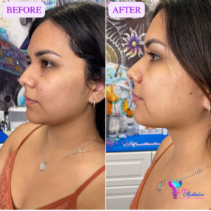 Jawline Enhancement with Dermal Fillers